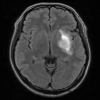 脳出血直後と1年後の脳の画像を比べてみよう
